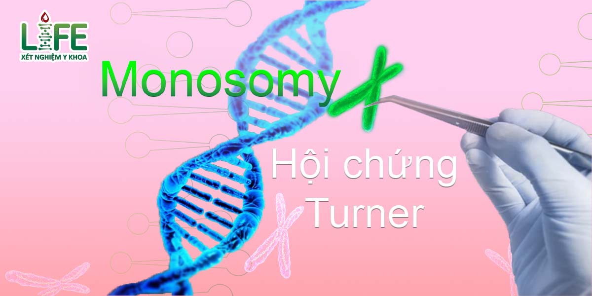 Hội chứng Turner - 45,X - Monosomy X - TRUNG TÂM XÉT NGHIỆM Y KHOA ...