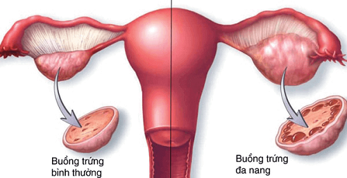 Buồng trứng đa nang - PCOS (Polycystic Ovary Syndrome - TRUNG TÂM XÉT  NGHIỆM Y KHOA LIFE